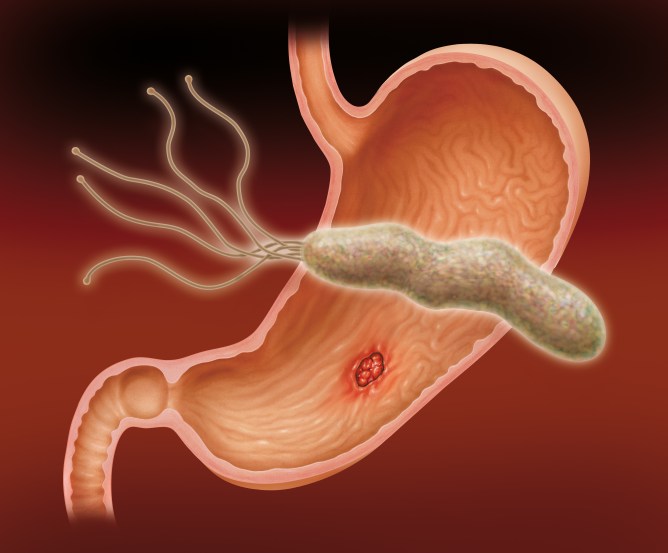 Magengeschwür || Ulcus ventriculi