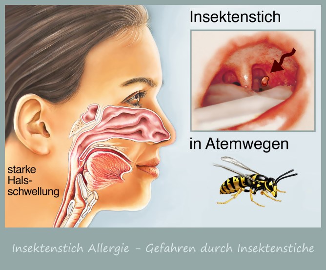 Allergiker Wespenallergie Atemnot | Insektenstich in den Atemwegen