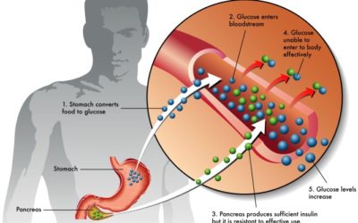 Typ-2-Diabetes – Bitterer Blutzucker