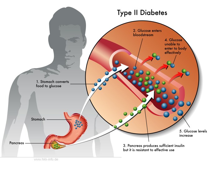 typ-2-diabetes © Fotolia.com